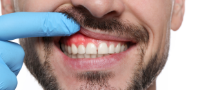 Como identificar e tratar a gengivite